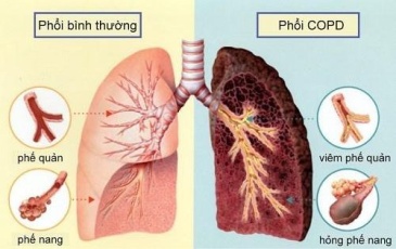 Bệnh phổi tắc nghẽn mạn tính COPD là gì? Nên điều trị tại đâu?